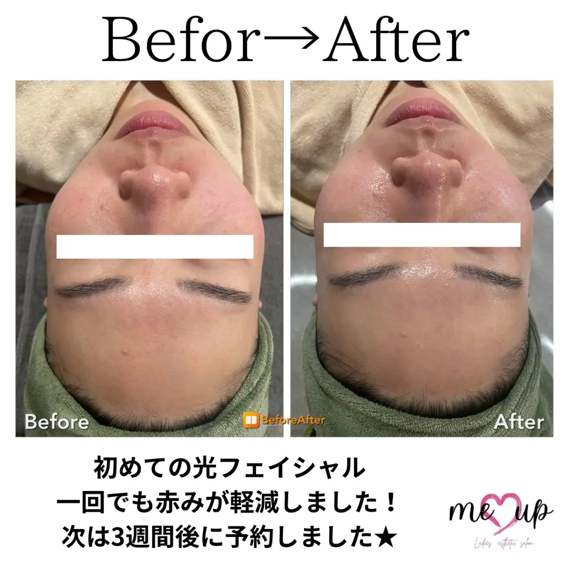 エステ Meupニキビ専門店 背中/ハーブ/肌管理のその他イメージ