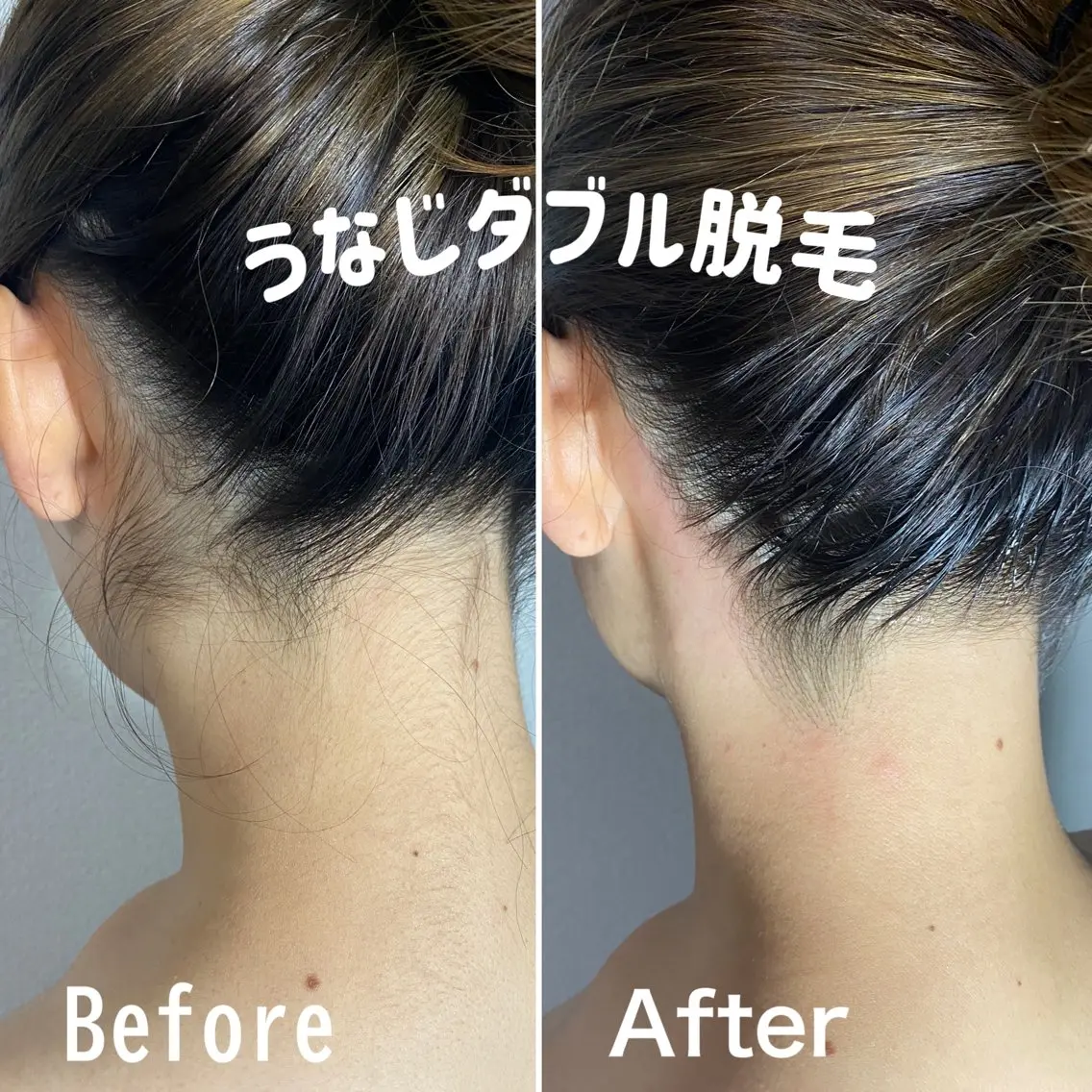 🌹ミニモ予約率No.1🌹うなじダブル脱毛(WAX＋高速光脱毛)【目指せうなじ美人✨🤍】◎口コミ必須の写真