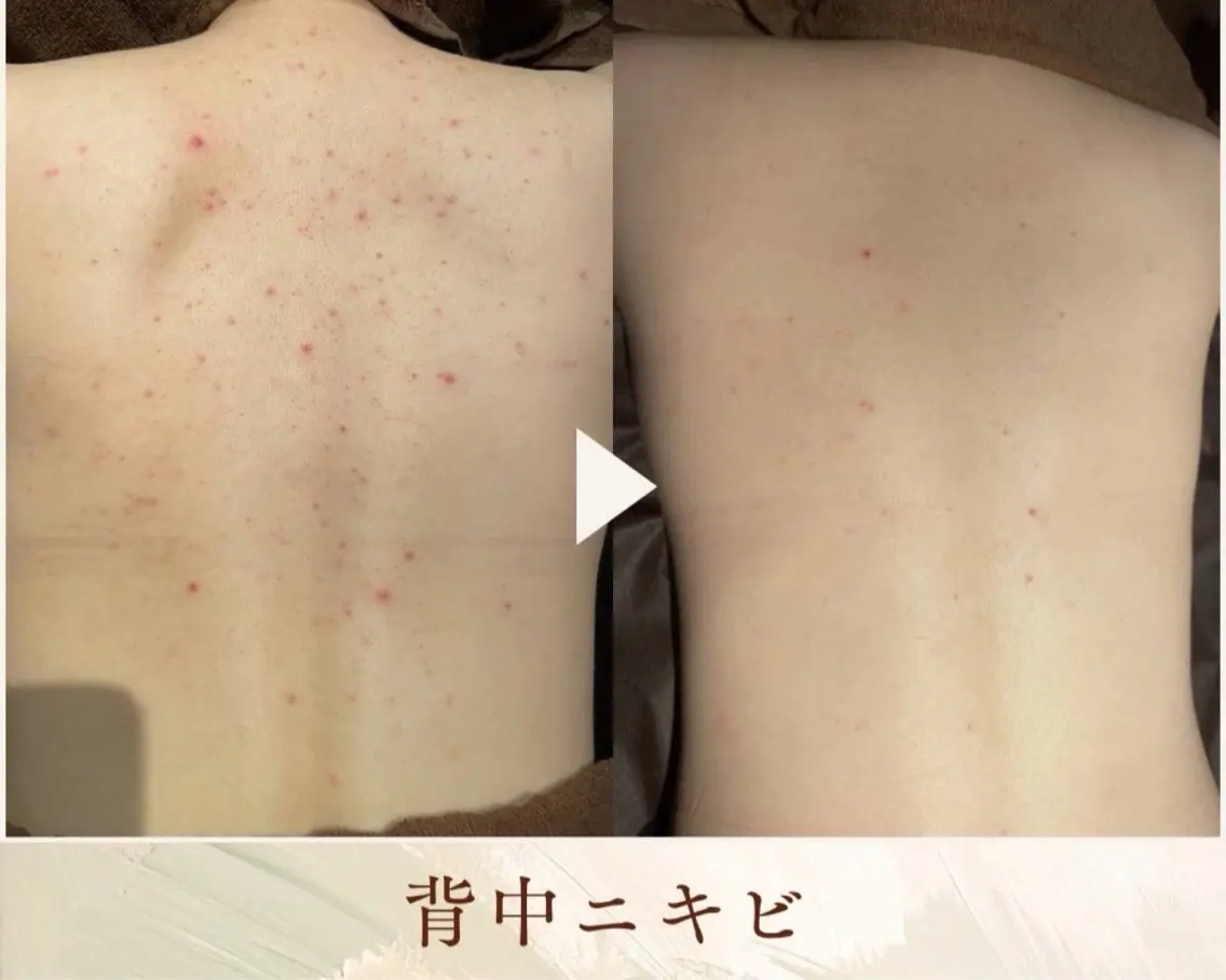 ハーブピーリング 【ボディ】の写真