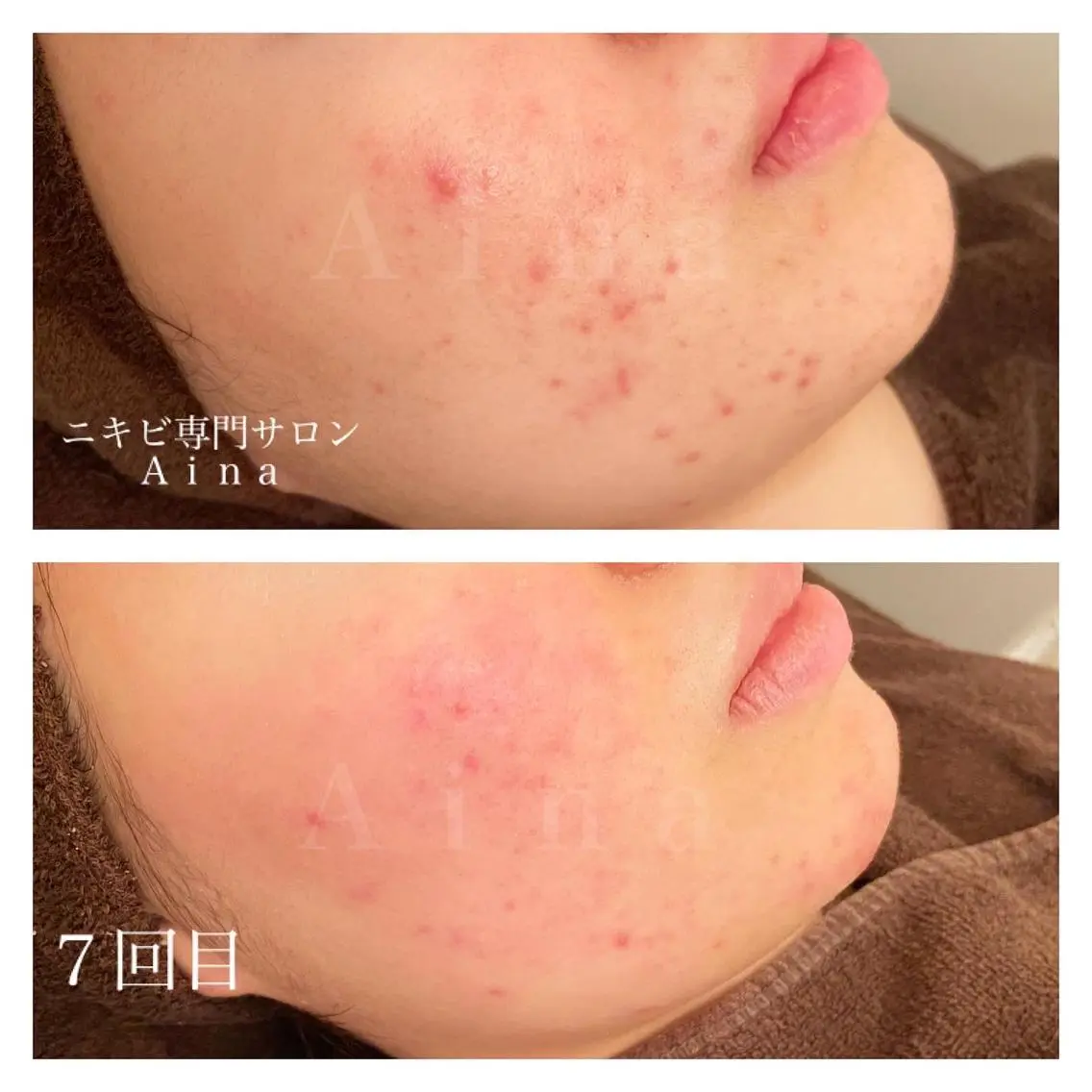 ミディアム カラー パーマ ヘアアレンジ メンズ キッズ ネイル マツエク・マツパ 赤色 エステ リラク ニキビ跡専門サロン Ａｉｎａのエステ・リラクイメージ