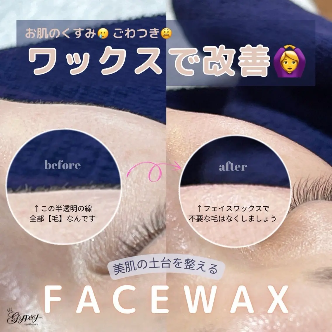 無料モデル✨【フェイシャルワックス】産毛処理◎ワントーン明るいお肌に!の写真
