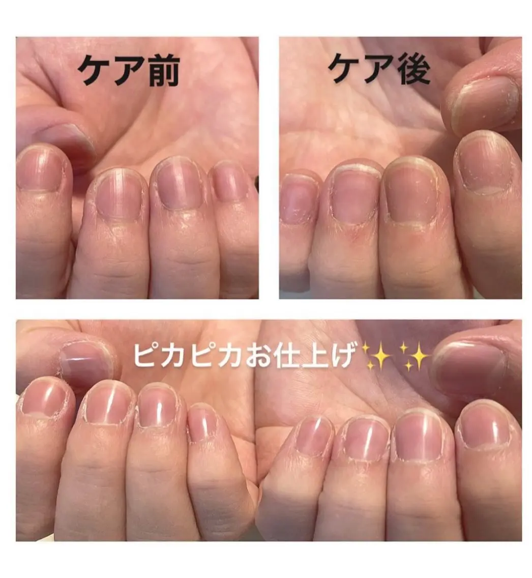 自爪ケアコースの写真