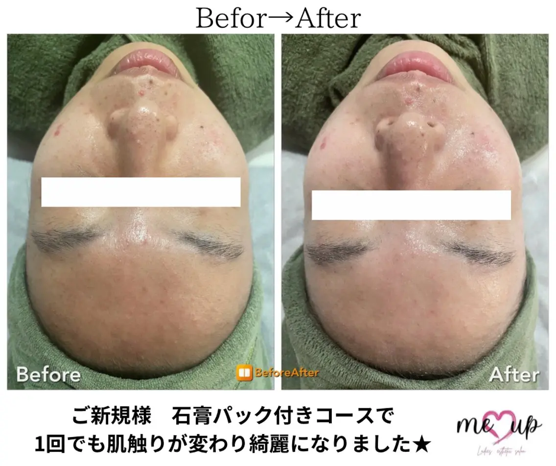 Meupニキビ専門店 背中/ハーブ/肌管理のその他イメージ