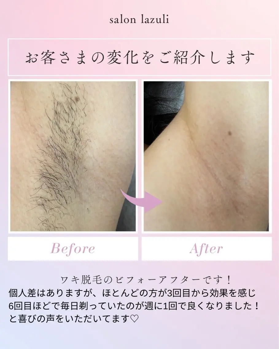 【全員/男女/自己処理によるくすみ・ポツポツに】両脇ワックス+光脱毛¥2980の写真