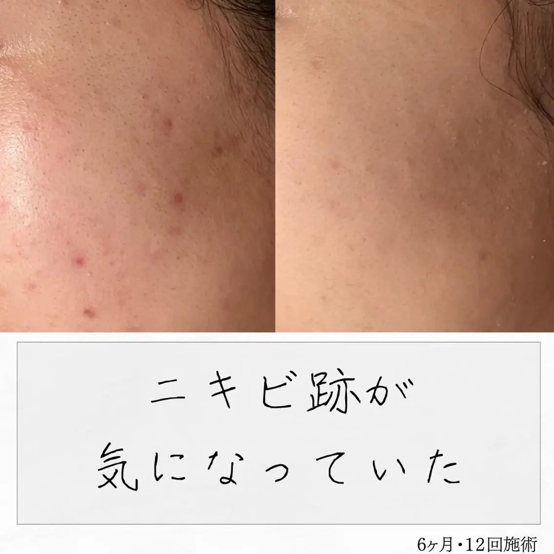 ニキビ経験者が施術 する専門サロン🌻のエステ・リラクイメージ