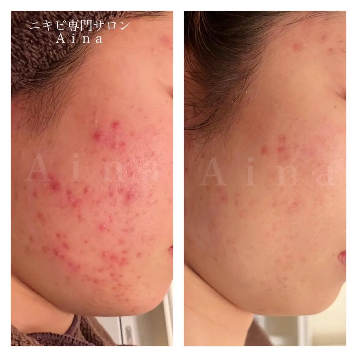 セミロング カラー パーマ ヘアアレンジ メンズ キッズ ネイル マツエク・マツパ アイブロウ 赤色 エステ リラク ニキビ跡専門サロン Ａｉｎａのエステ・リラクイメージ