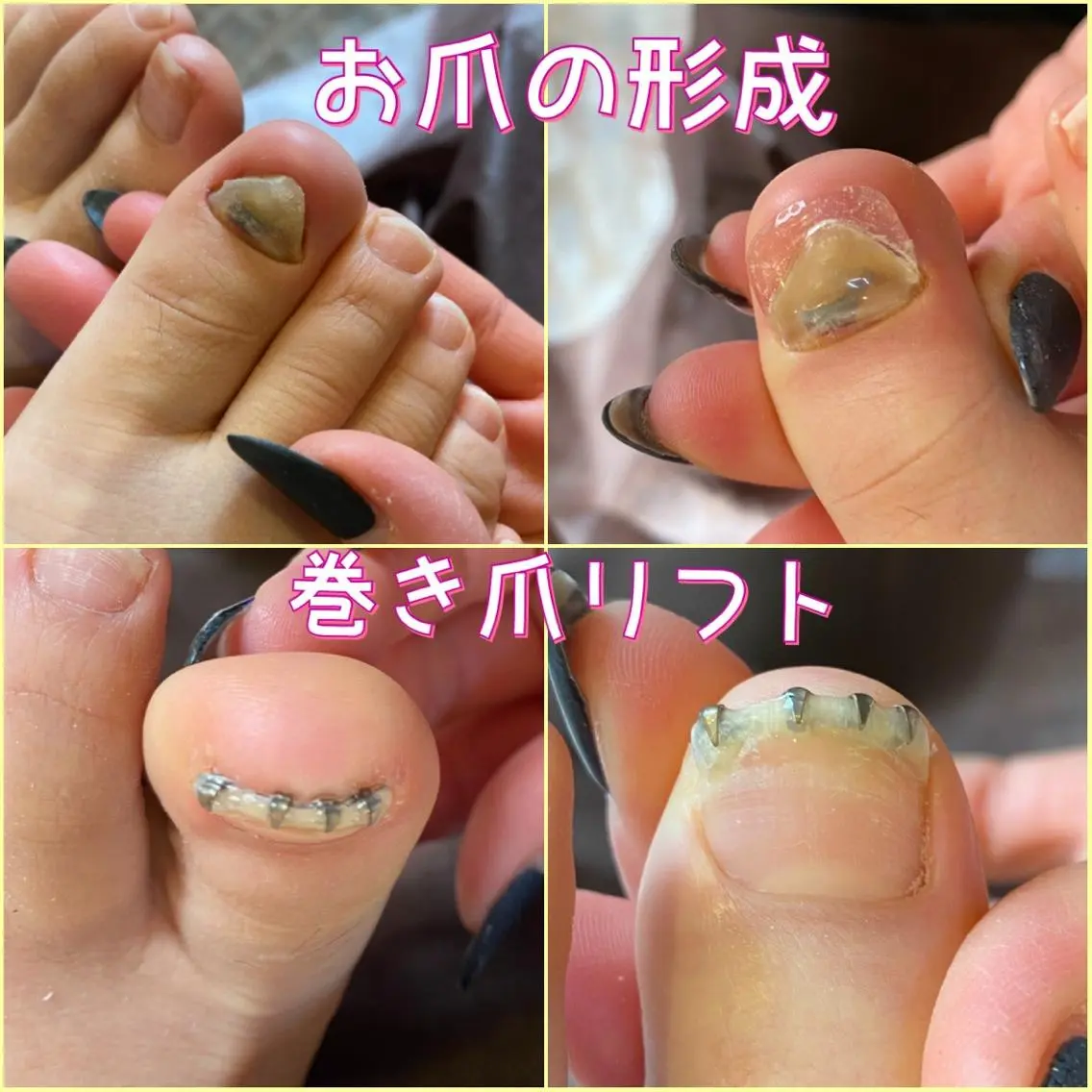 ネイル ジェルネイル ♢ME2ROOM♢ #巻き爪#リラクのネイルデザイン