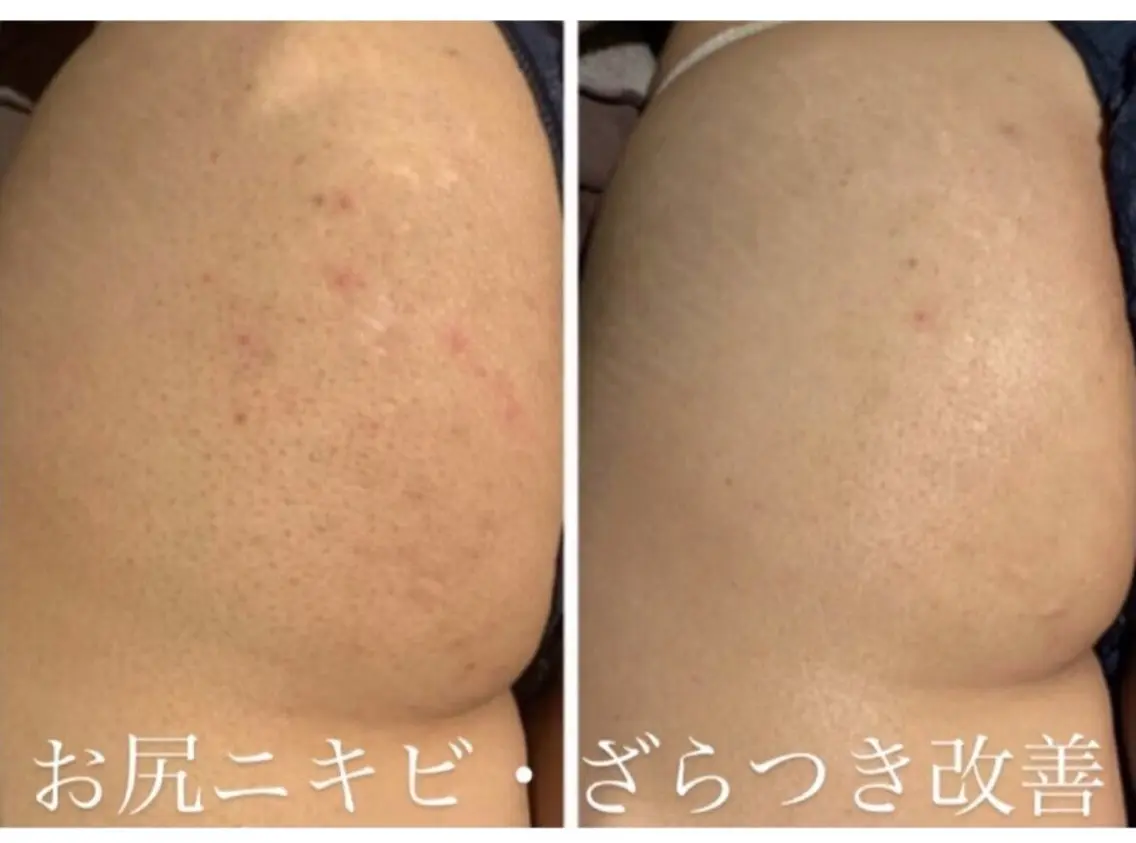 🌱【今月・ご新規様限定】🕊️見せたくなる美尻へ◎お尻ハーブピーリングの写真