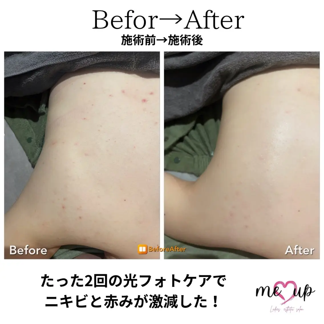 エステ Meupニキビ専門店 背中/ハーブ/肌管理のその他イメージ