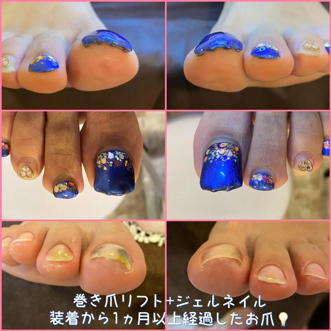 ネイル ジェルネイル ♢ME2ROOM♢ #巻き爪#リラクのネイルデザイン