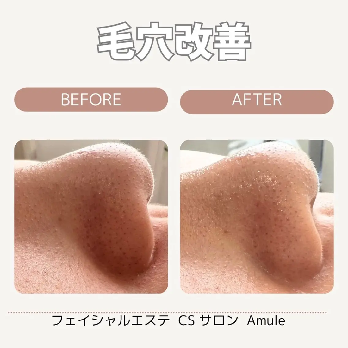 毛穴ケア✨乾燥テカリ改善コース☘️の写真