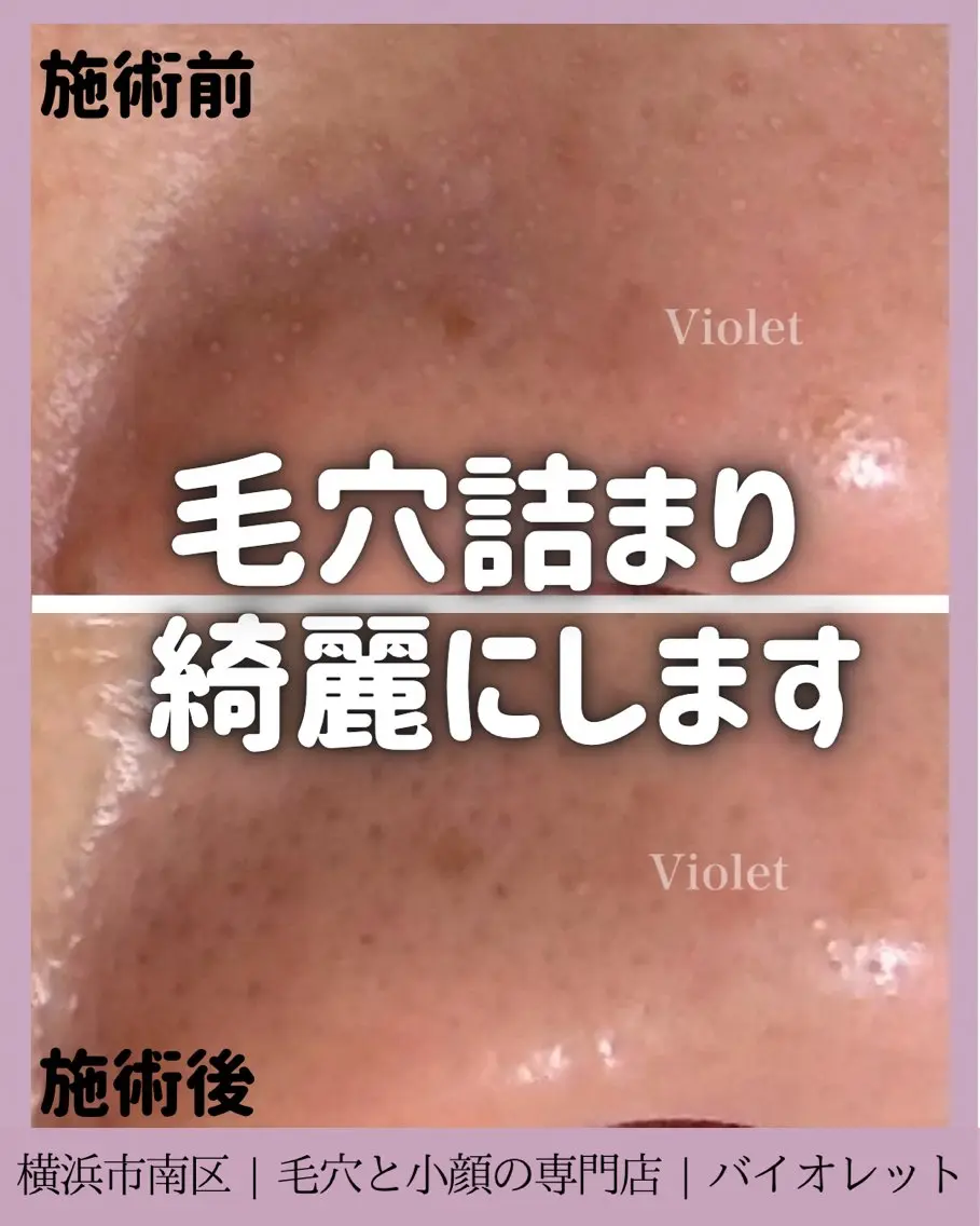 その他 毛穴と耳つぼ専門店 バイオレット　りののその他イメージ