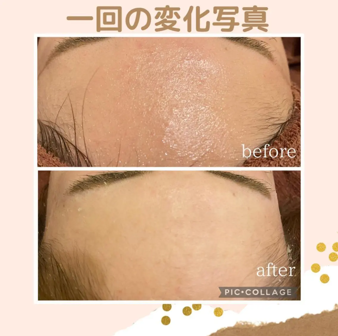 3か月で肌革命👼 ニキビ専門店💫のエステ・リラクイメージ