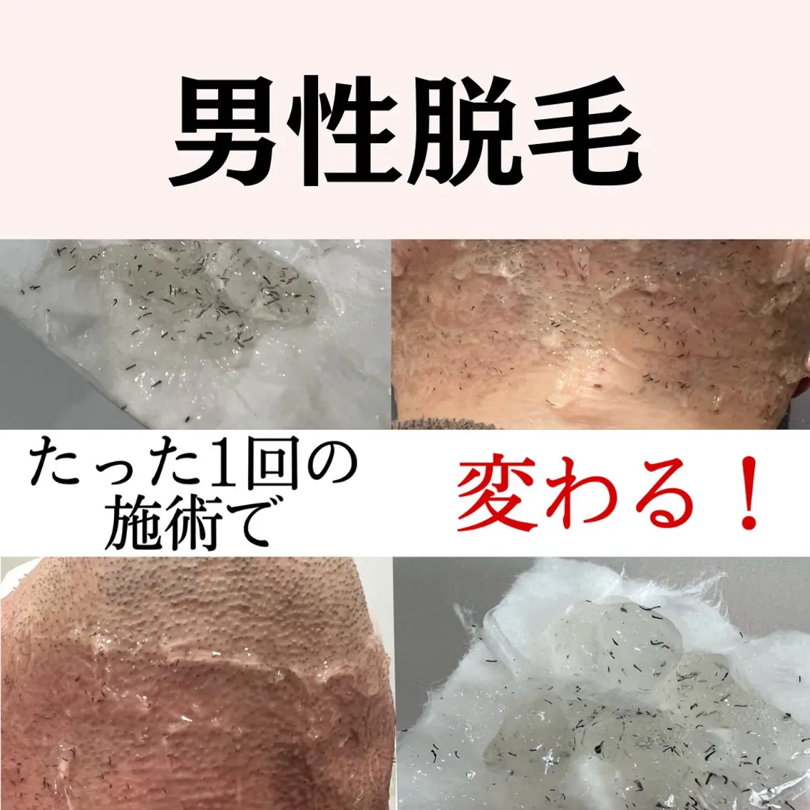 脱毛 🌼SALON Lazuli久留米のエステ・リラクイメージ