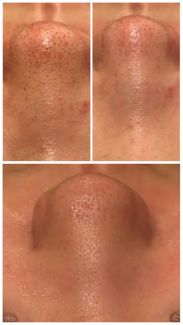 毛穴気になる方はこれ!!毛穴レスケア✨️の写真