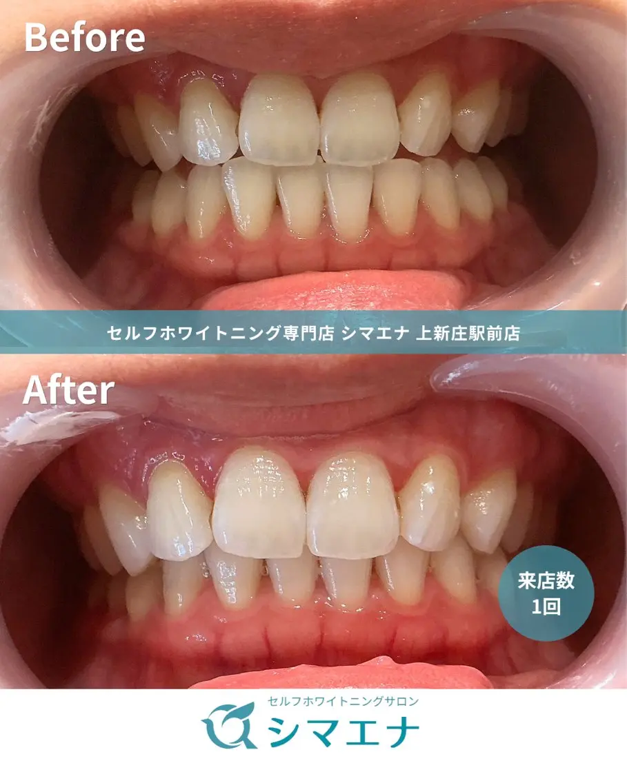 その他 セルフホワイトニング シマエナのその他イメージ