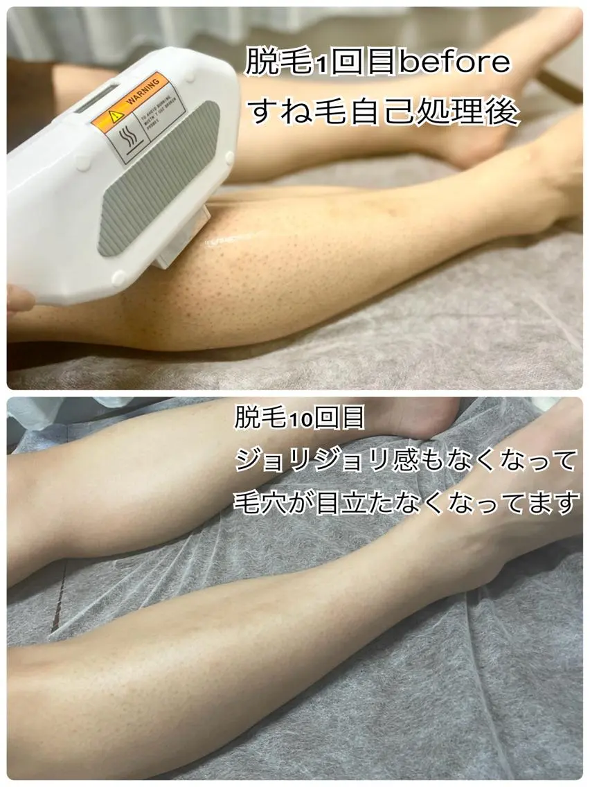 【全身脱毛1回】メンズ専用🤵♂️次世代SHR脱毛(顔・VIOあり)※vioはセルフ施術、スタッフ施術は+5000円の写真