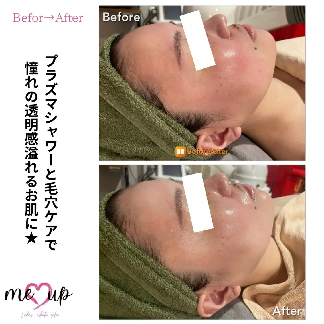 エステ Meupニキビ専門店 背中/ハーブ/肌管理のその他イメージ