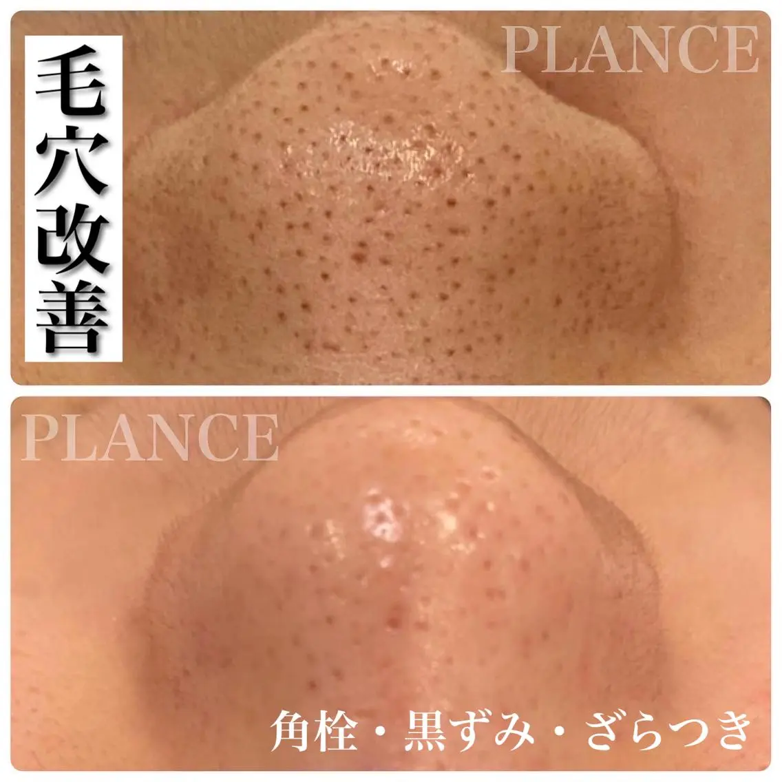 30分クイックフェイシャル!毛穴改善アンケートモニター募集👃の写真