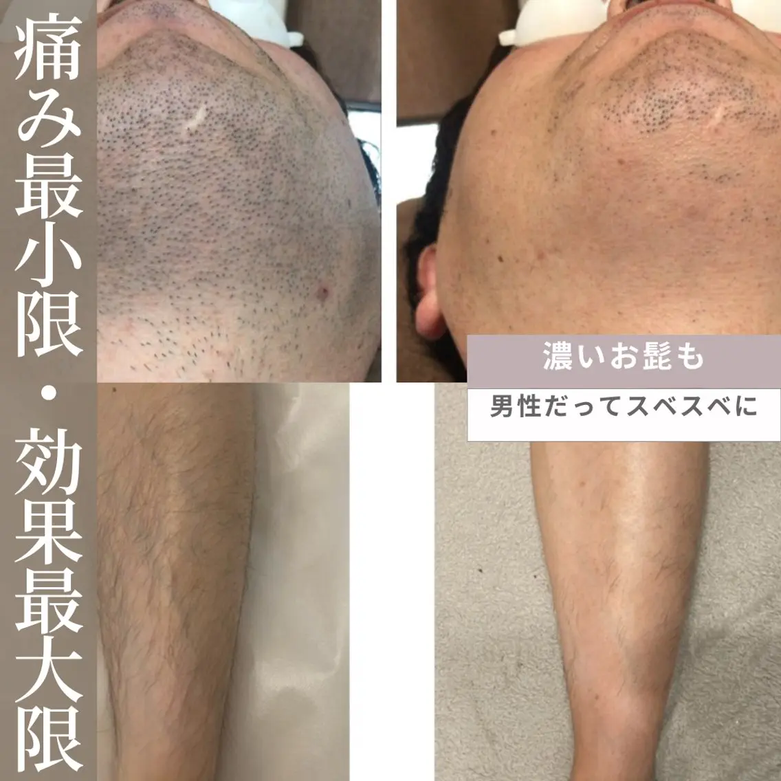 メンズ脱毛🎩👔👞  【顔・前上半身・後ろ上半身・VIO・脚(膝上下)・手(肘上下)】から 2箇所除くメニューの写真