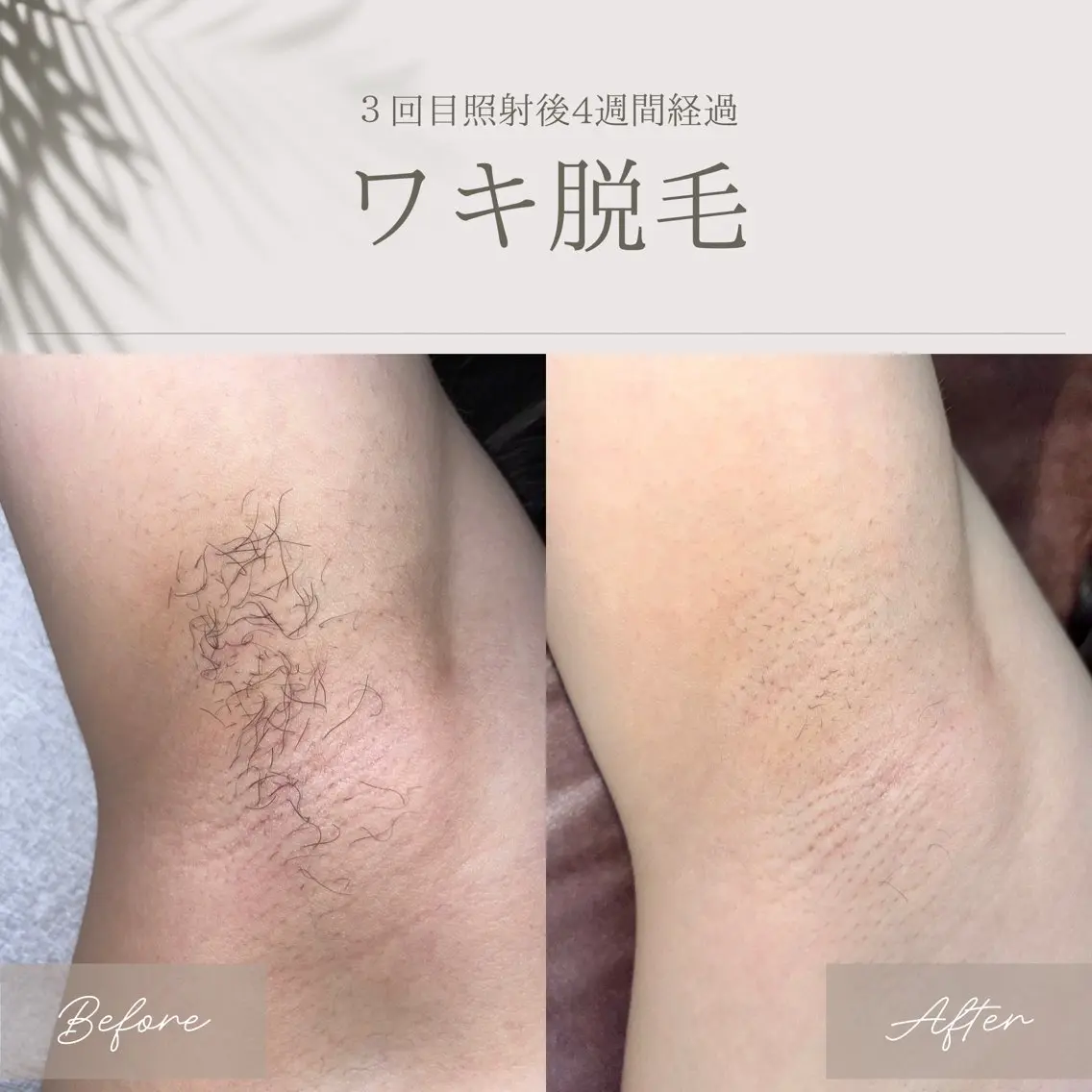脱毛 脱毛サロン ATENAのエステ・リラクイメージ