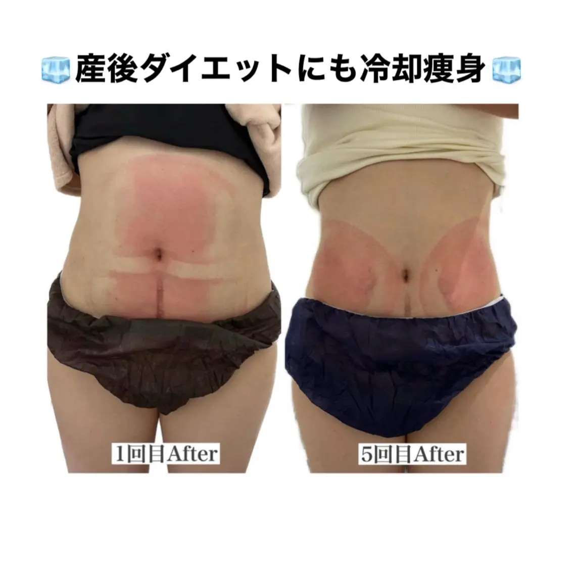 【2部位】冷却痩身❄️の写真