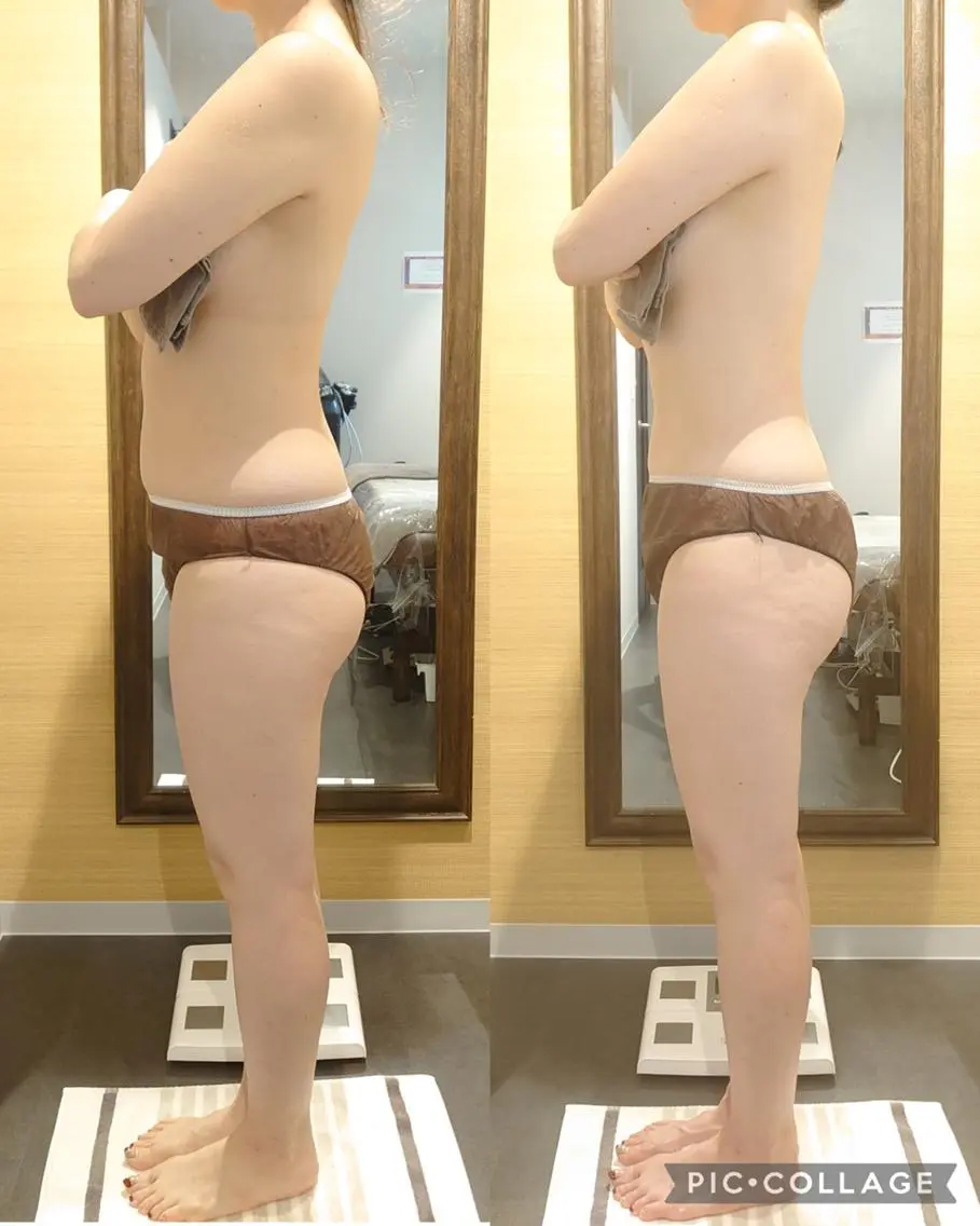 【夏前に!】美くびれゲット🌟気になるぽっこりお腹にサヨナラを! ラジキャビ20分&腸揉み・燃焼マッサージ10分の写真