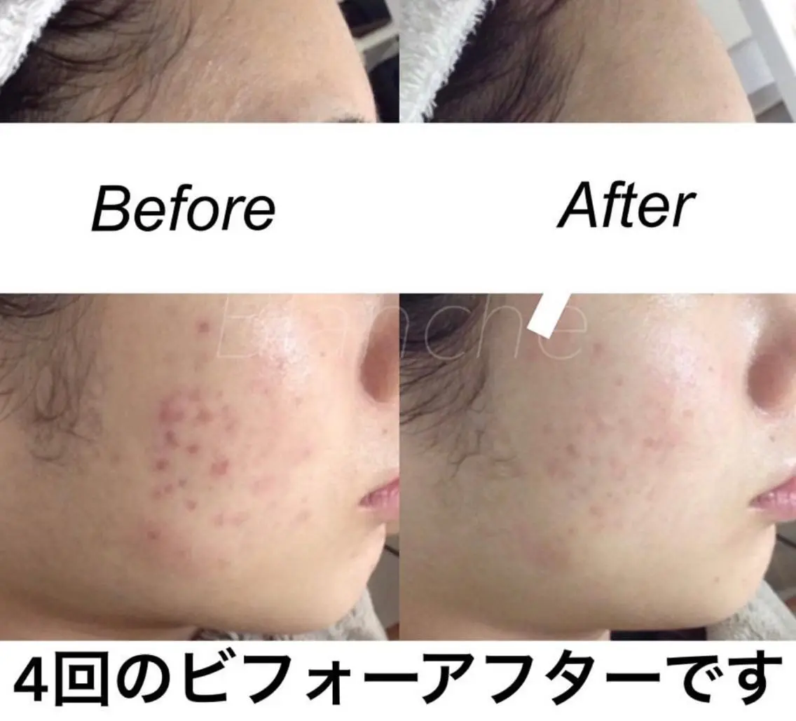 セミロング カラー パーマ ヘアアレンジ ネイル マツエク・マツパ エステ リラク 都度払い肌質改善 &脱毛Blancheのエステ・リラクイメージ