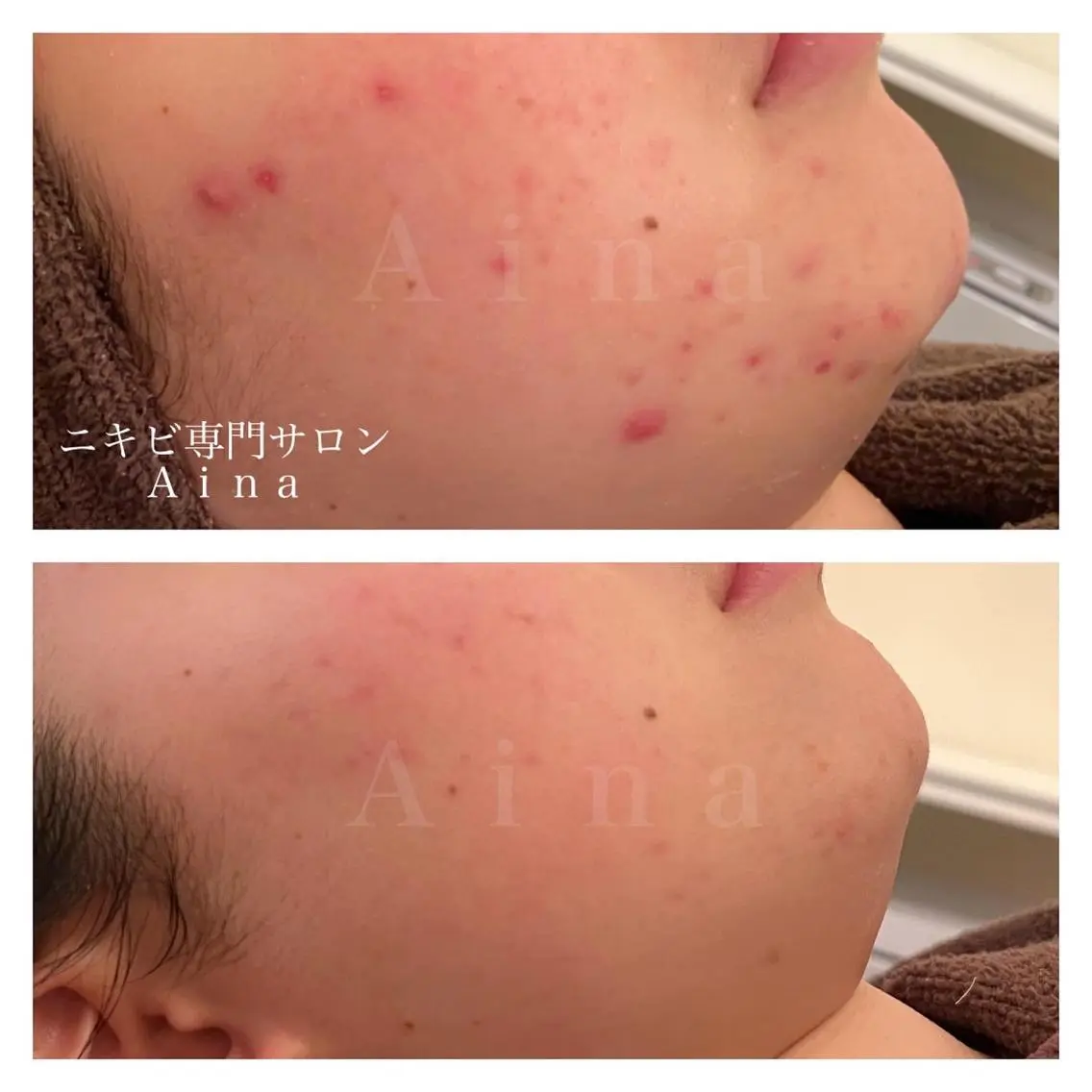 ミディアム カラー パーマ ヘアアレンジ メンズ キッズ ネイル マツエク・マツパ アイブロウ 学生（メンズ向け） 学生 ニキビ跡専門サロン Ａｉｎａのエステ・リラクイメージ