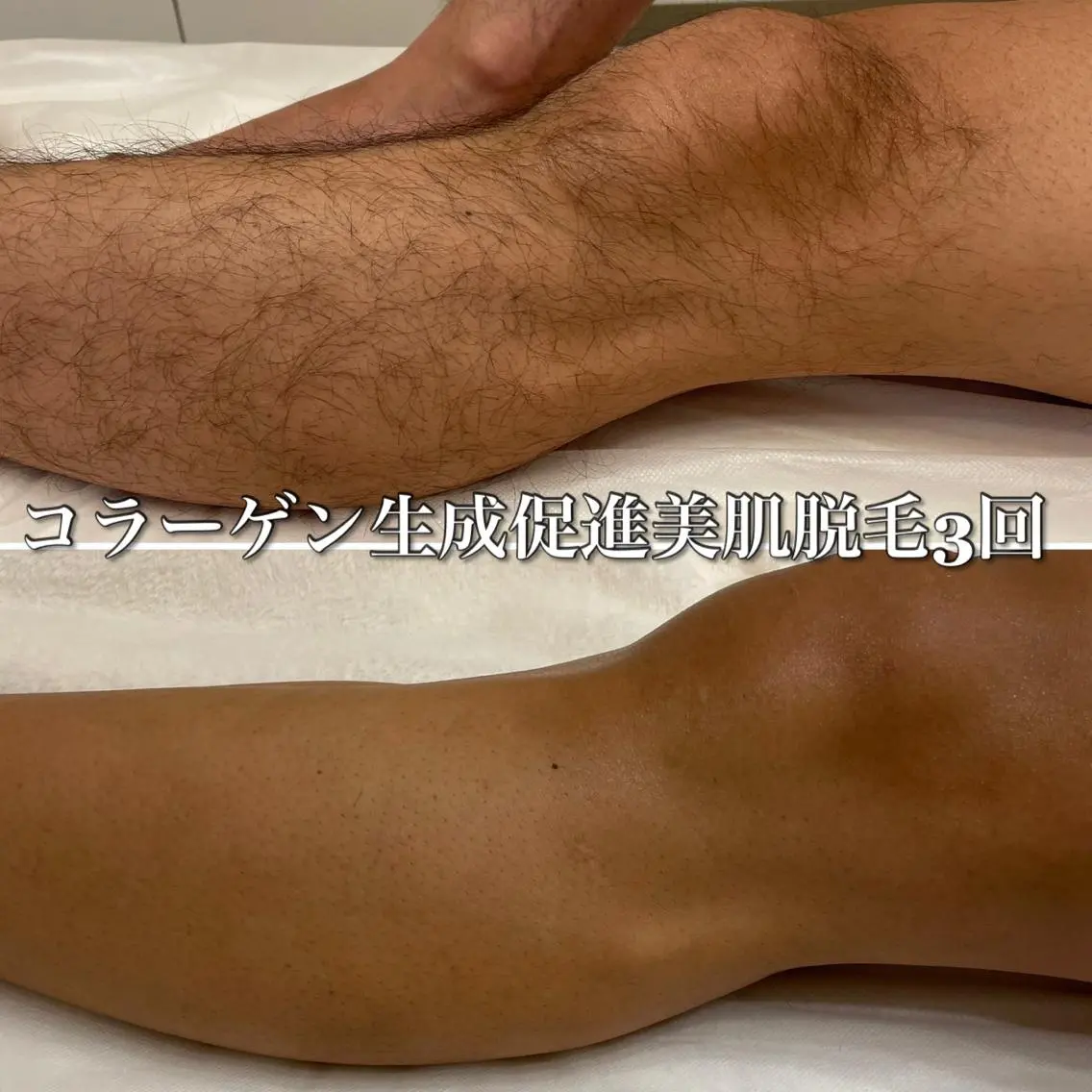 ●ミニモ限定【ひざ下+足の甲・指】メンズ◎¥4000の写真