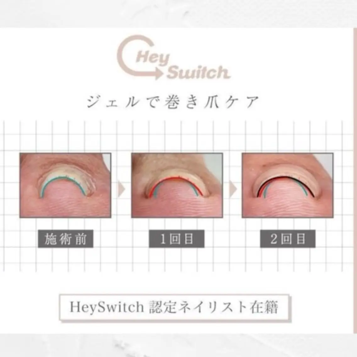 【巻き爪・食い込み改善】特殊ジェル巻き爪ケア✨の写真