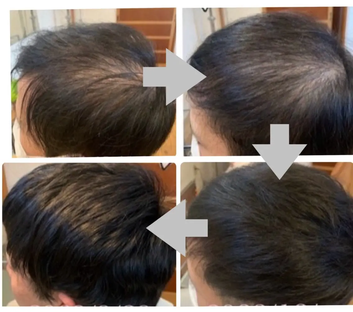 メンズ ヘッドスパ 抜毛 薄毛 白髪 頭皮改善 柳沢慶のヘアスタイル