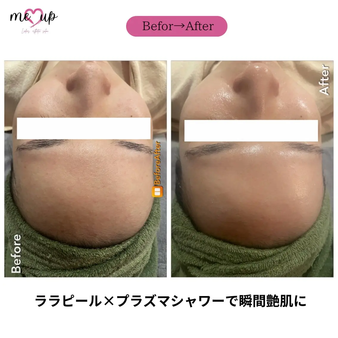 エステ Meupニキビ専門店 背中/ハーブ/肌管理のその他イメージ