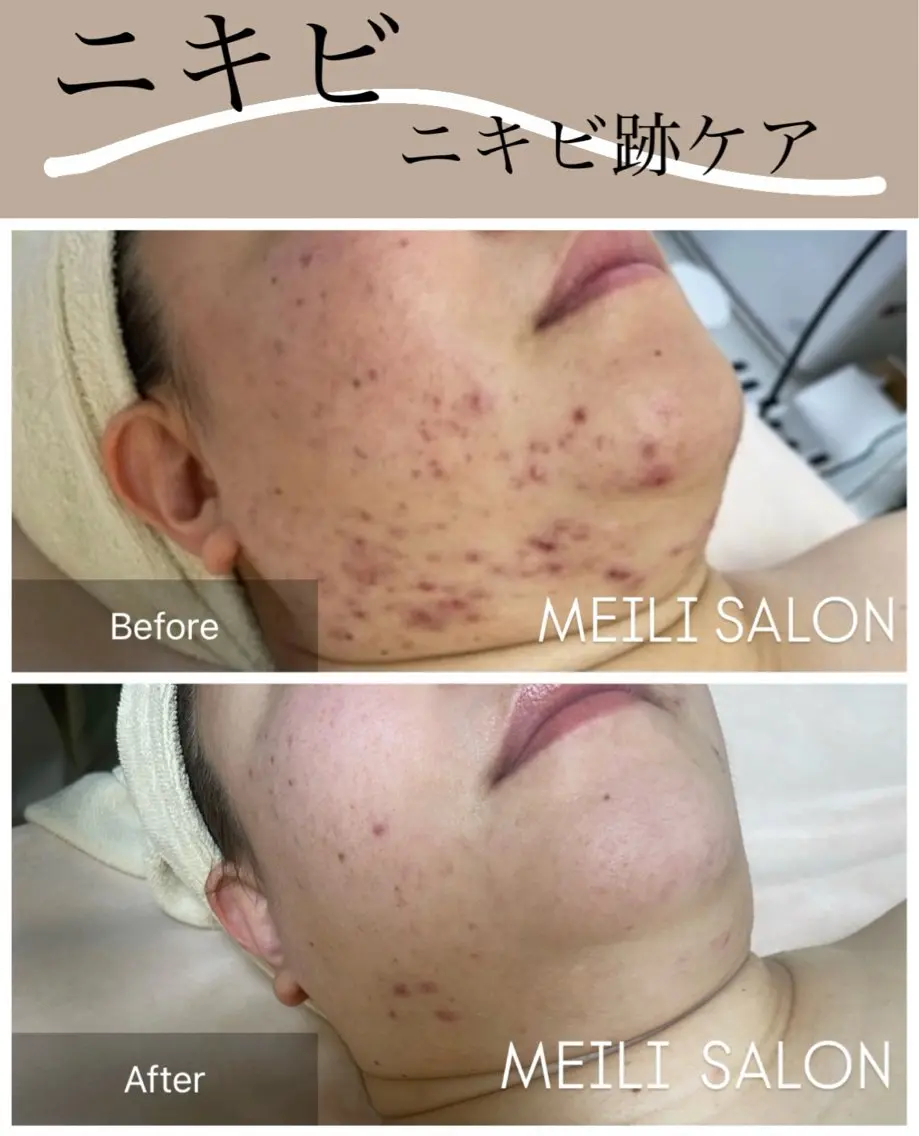 モニター様特別価格🙌【新ニキビ・ニキビ跡ケア】グリコール酸+E光フォト+最新ビタミンC導入¥14,000→¥8,980の写真