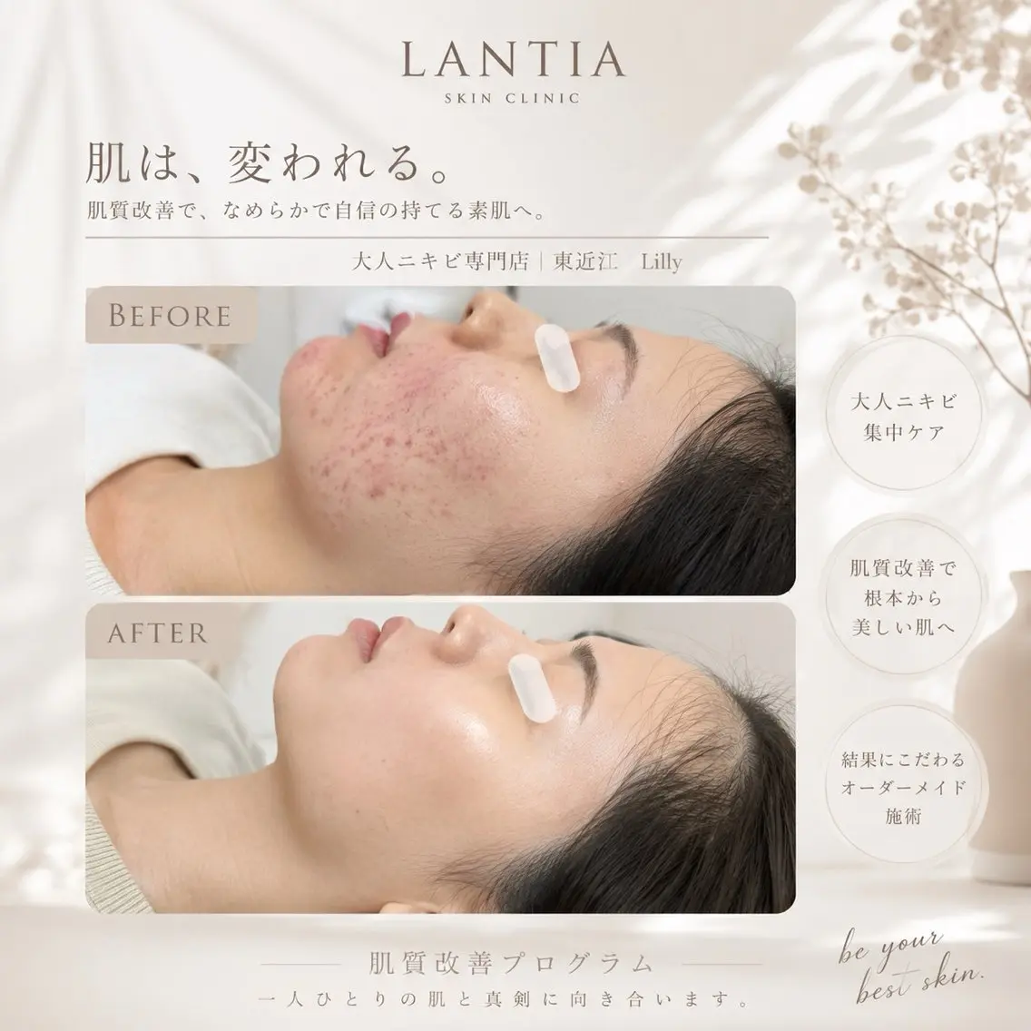 エステ LANTIA 肌改善ホワイトニングのその他イメージ