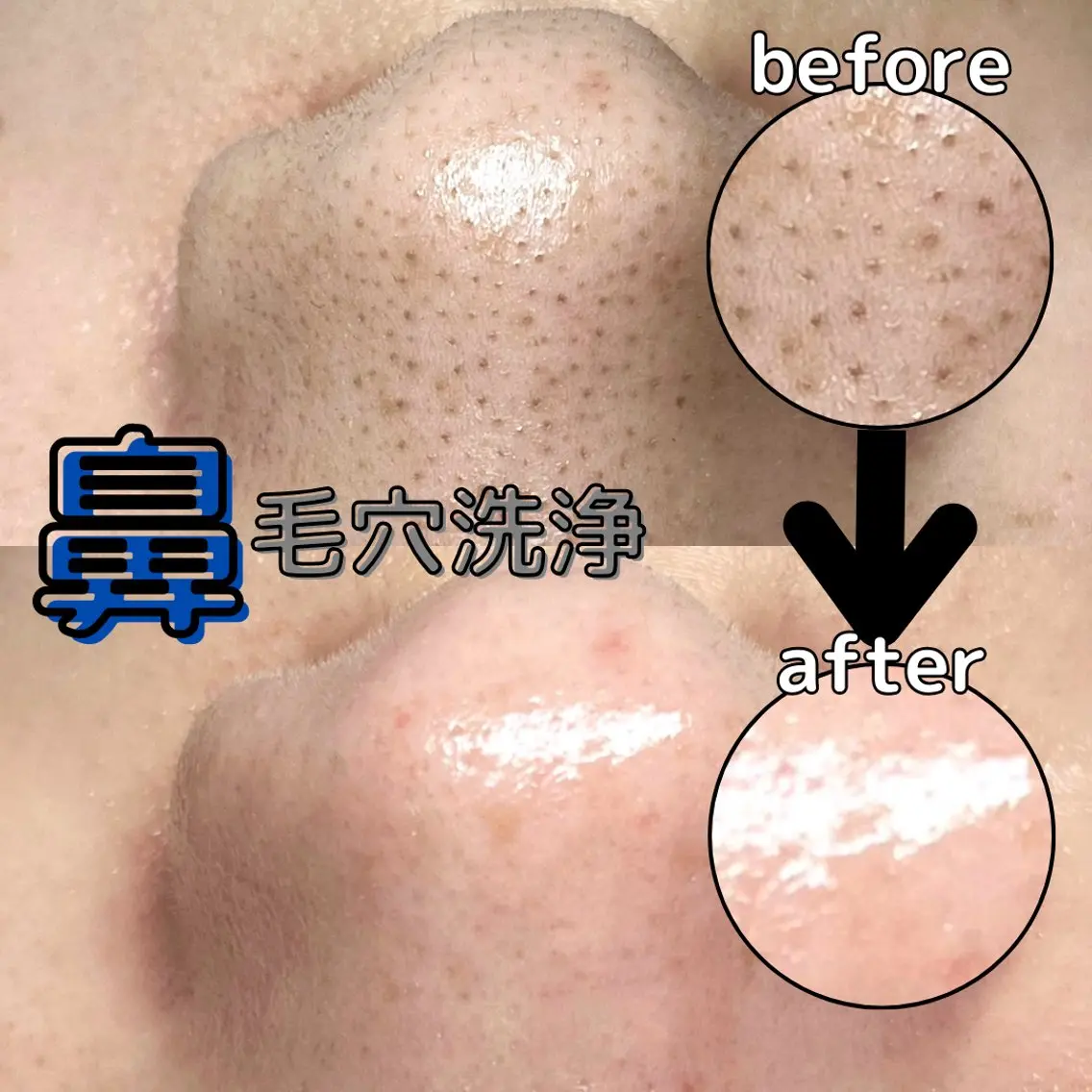 特別価格✨️🍓同時施術可能🍓【鼻だけ!👃毛穴洗浄💧】⏰45分の写真
