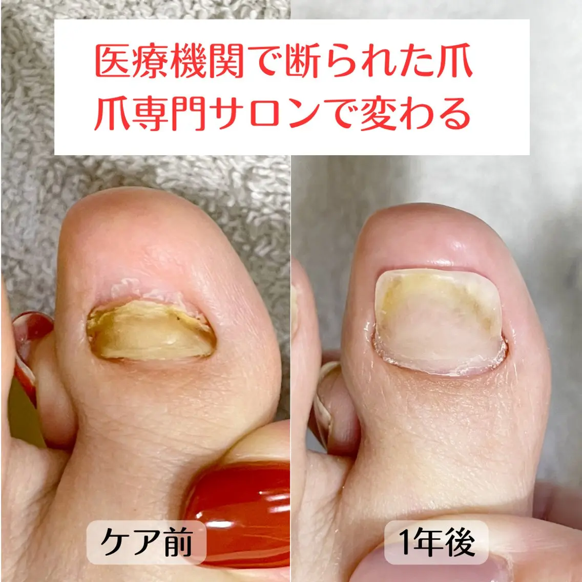 ネイル 深爪・巻き爪 専門サンセリテのネイルデザイン