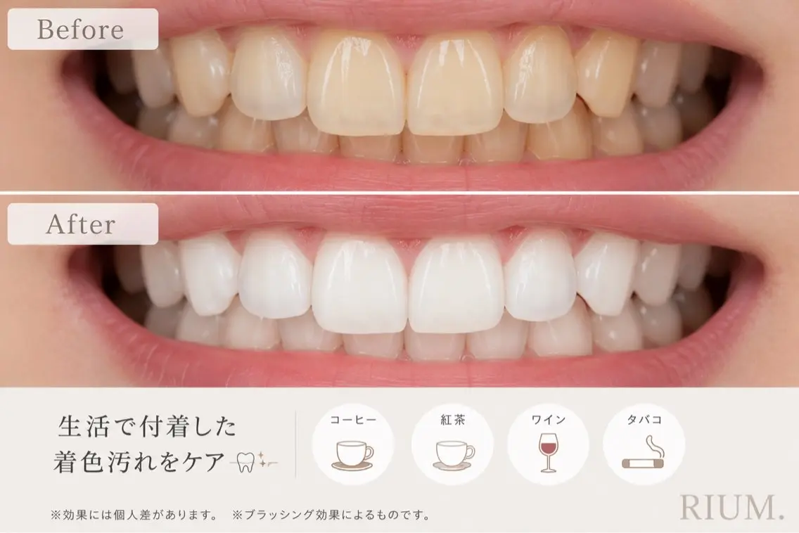 【まずはお試しクーポン】気軽に始めるホワイトニング🦷✨の写真