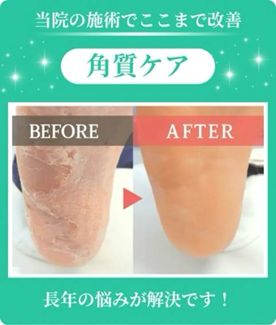 【初めての方】足裏トータル角質ケアの写真