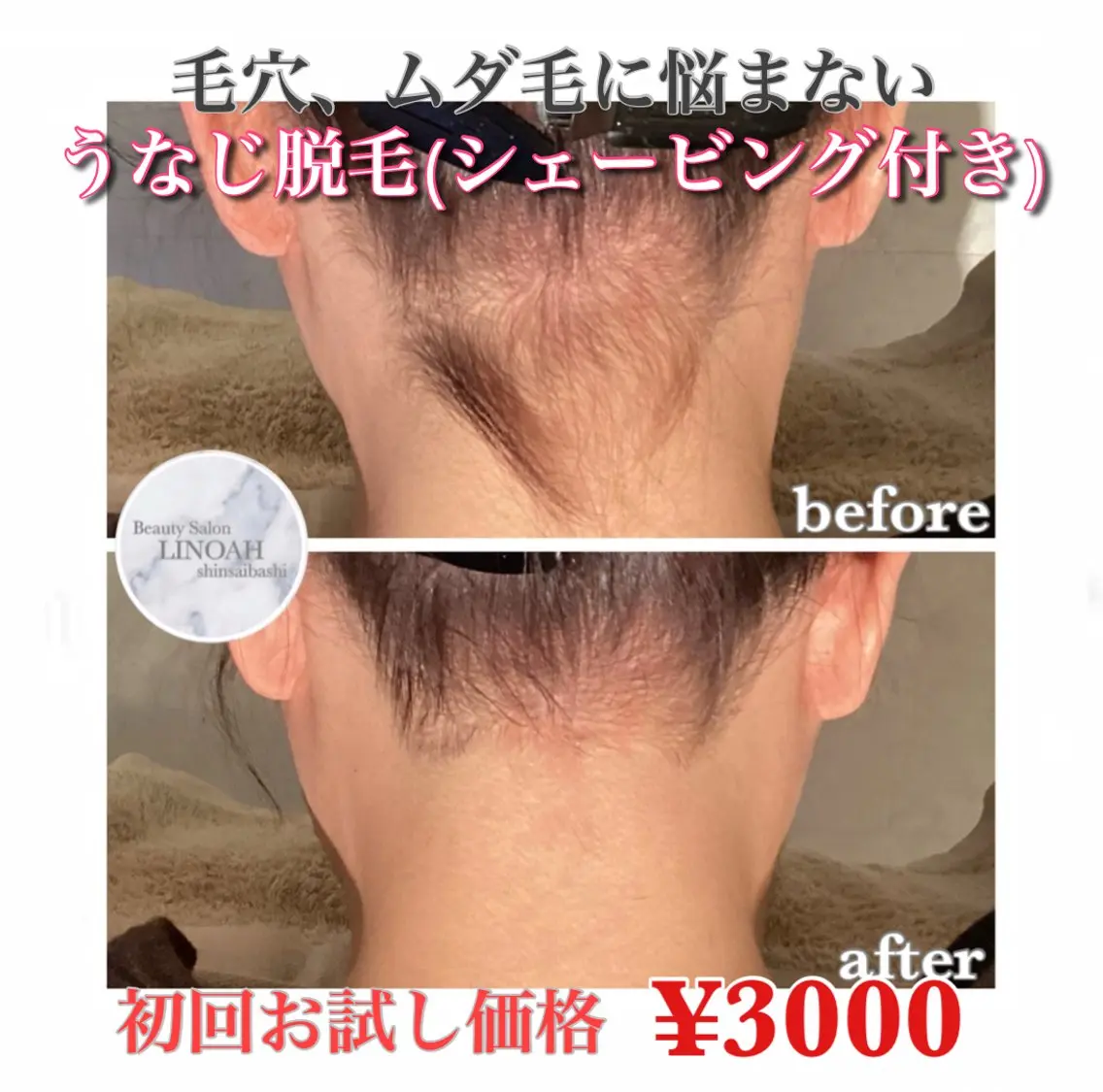🉐【毛穴/ムダ毛改善】うなじ脱毛 (シェービング付き) ¥4180 → ¥3000の写真