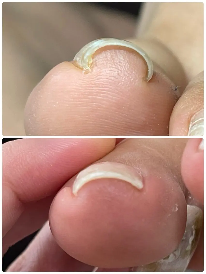 巻き爪ケア✯の写真