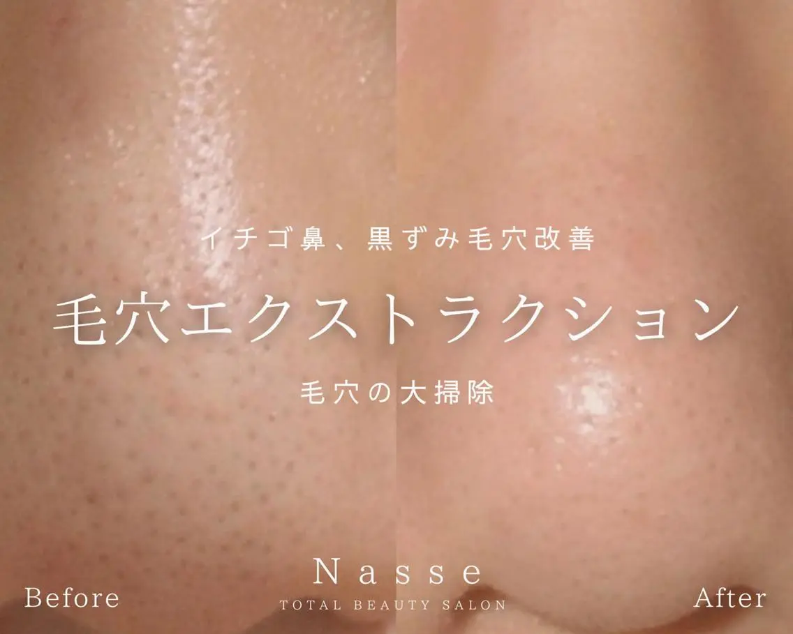 【☆大人気☆毛穴洗浄!!角栓・黒ずみ毛穴】話題の毛穴エクストラクション￥8800の写真