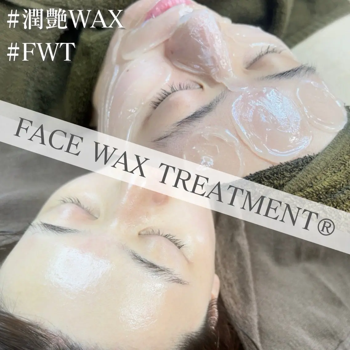 脱毛＋ピーリング✨潤艶Wax✨最高級フェイシャルワックストリートメント✨肌別パック付き♡の写真