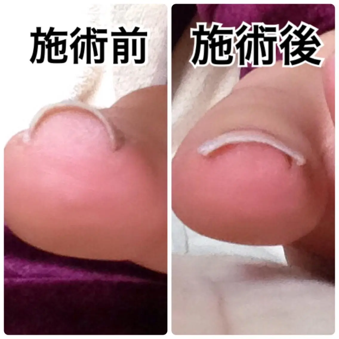 【初回限定】巻き爪補正(足)1本の写真