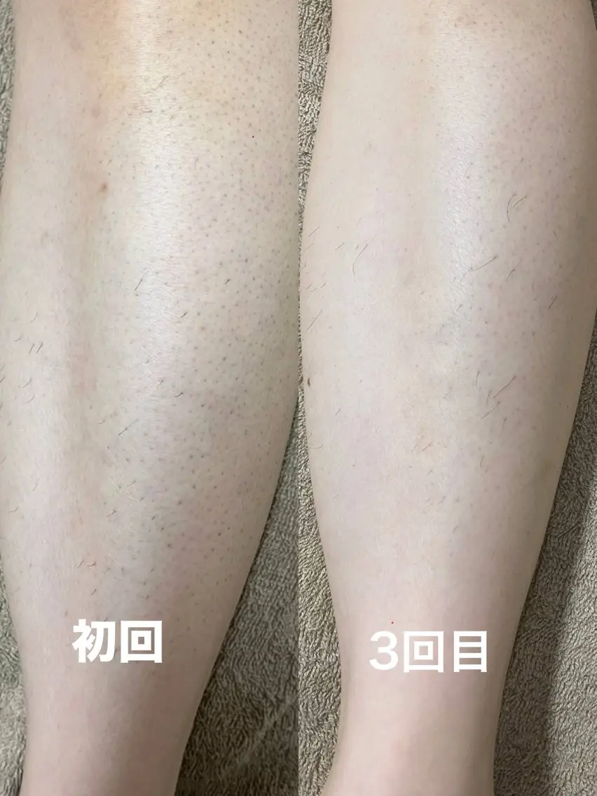 脱毛 【都度払い可】 脱毛 サロンドジェシカのエステ・リラクイメージ