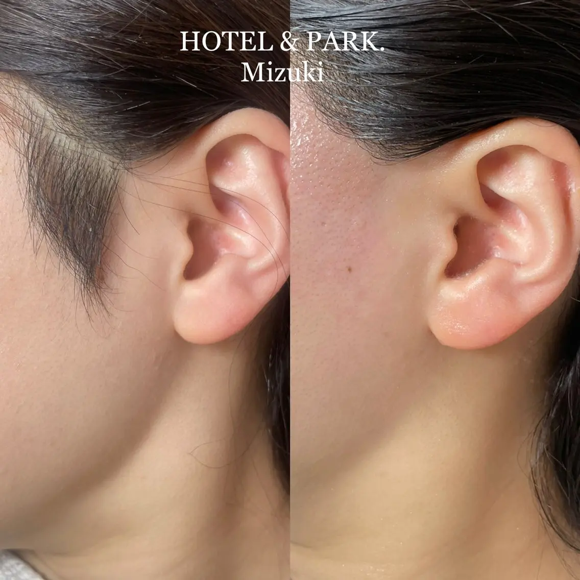 脱毛 HOTEL&PARK . ワックス脱毛のエステ・リラクイメージ
