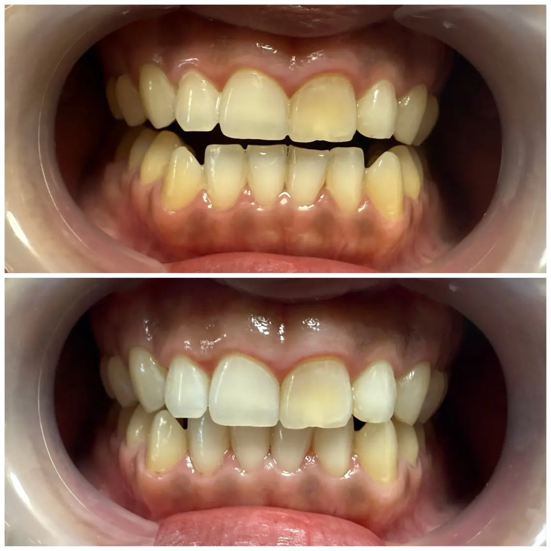 🦷セルフホワイトニング🦷初回お試し価格‼️3月末までの写真