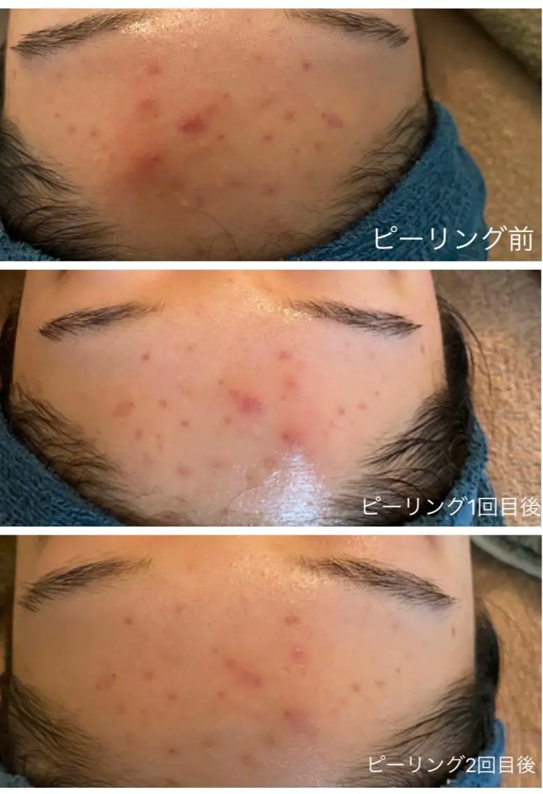 【ピーリング】+【マッサージ】ダブルの相乗効果でお肌スッキリ✨の写真