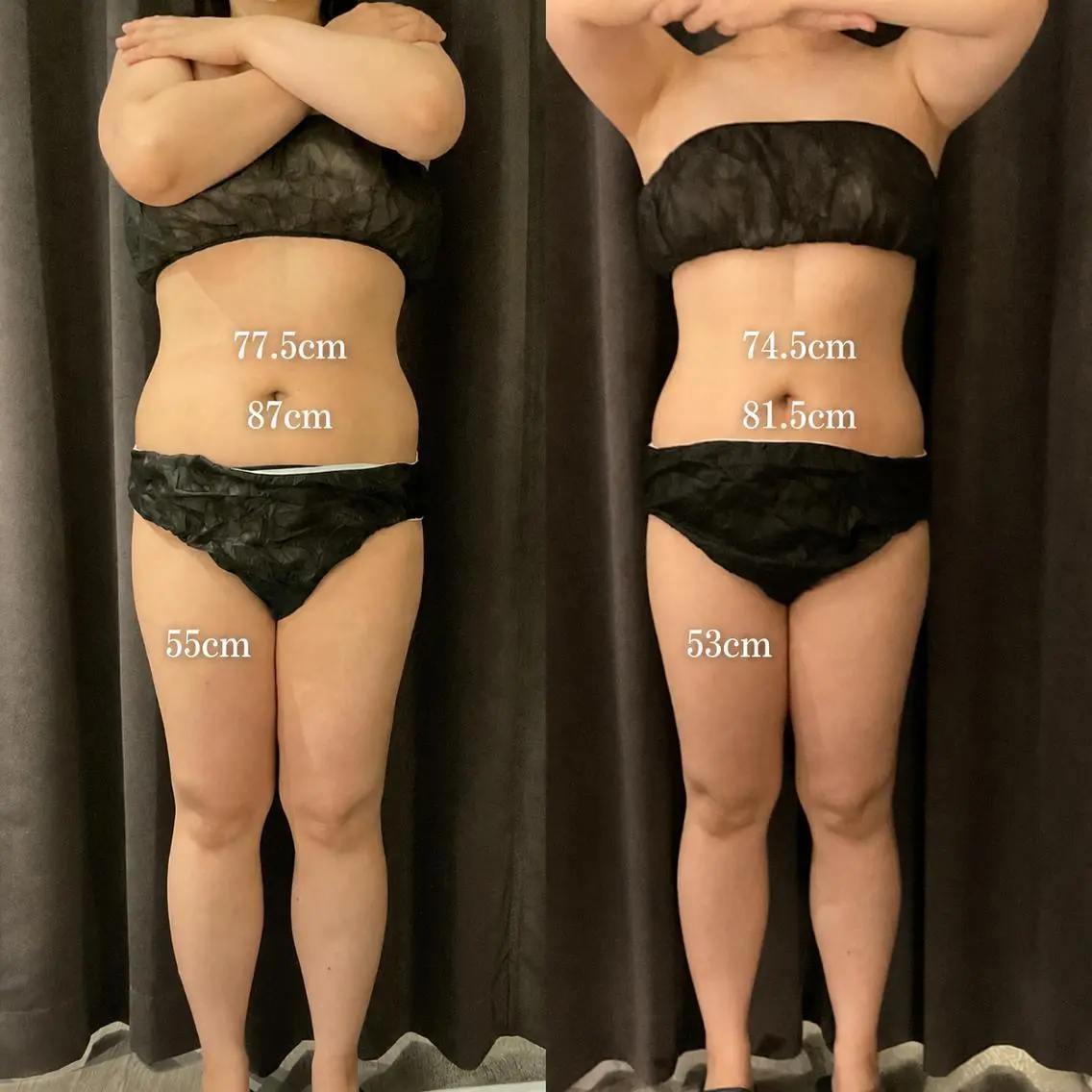 冷却ダイエット【筋膜リリース、引き締め美容液付き❗️】痩身❄️痩せたい部位の脂肪を集中アプローチ！1部位（2カップ）の写真
