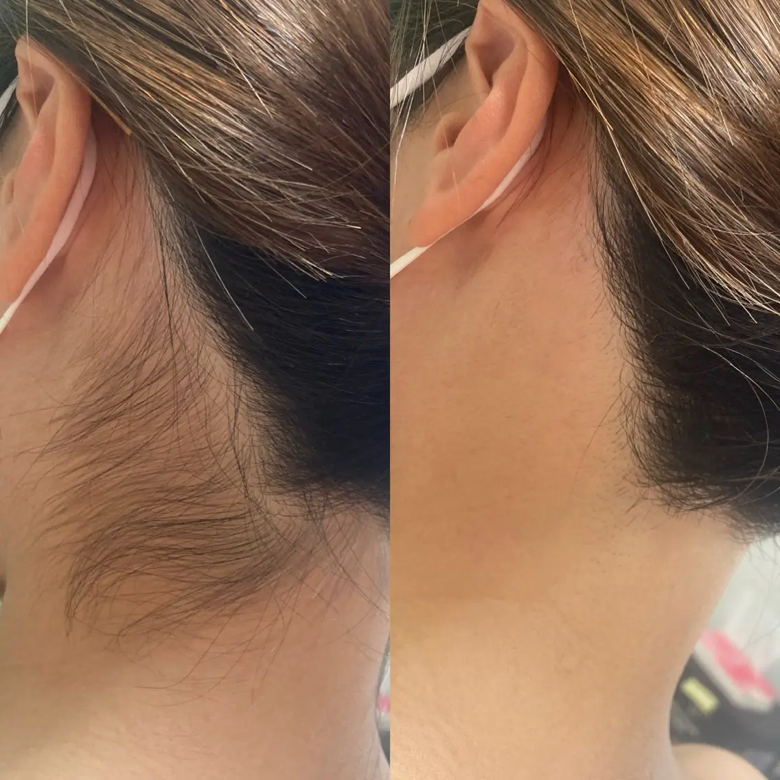 うなじシェービング＋光脱毛の写真